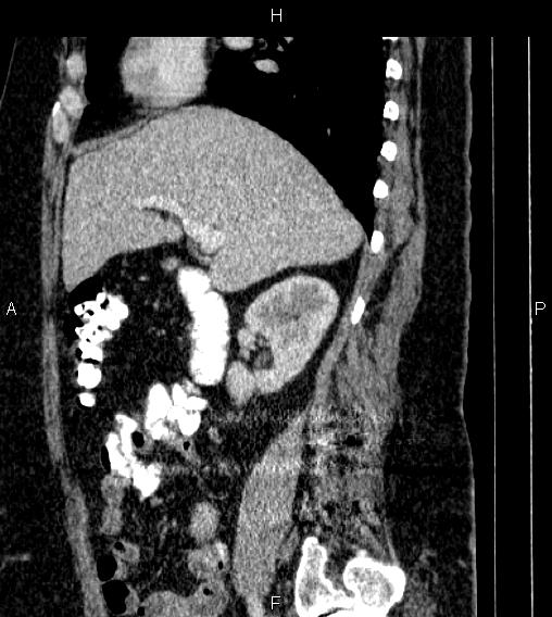 Adrenal myelolipoma (Radiopaedia 84319-99617 Sagittal renal cortical phase 33).jpg