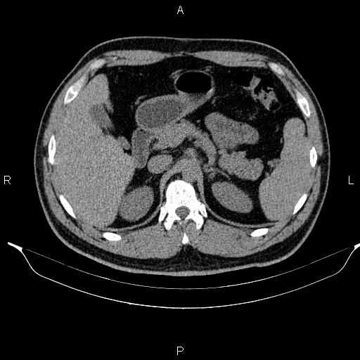 Adrenal myelolipoma (Radiopaedia 84321-99619 Axial non-contrast 35).jpg