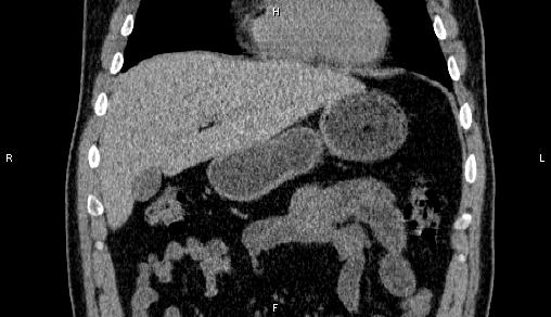 Adrenal myelolipoma (Radiopaedia 84321-99619 Coronal non-contrast 22).jpg
