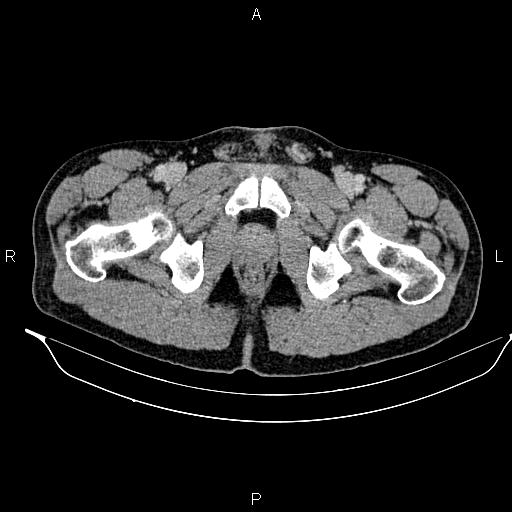 Adrenal myelolipoma (Radiopaedia 87794-104246 Axial renal cortical phase 110).jpg