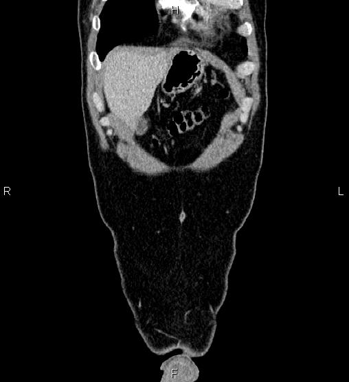 Adrenal myelolipoma (Radiopaedia 87794-104246 Coronal renal cortical phase 5).jpg