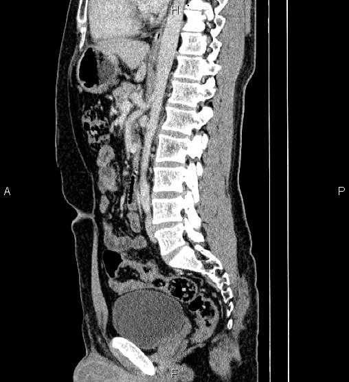 Adrenal myelolipoma (Radiopaedia 87794-104246 Sagittal renal cortical phase 52).jpg