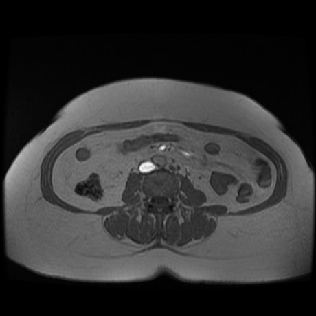 File:Adrenal myelolipoma - MRI (Radiopaedia 83249-97646 Axial T1-in phase 25).jpg
