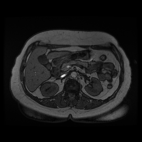 File:Adrenal myelolipoma - MRI (Radiopaedia 83249-97646 T1 out-of-phase 12).jpg