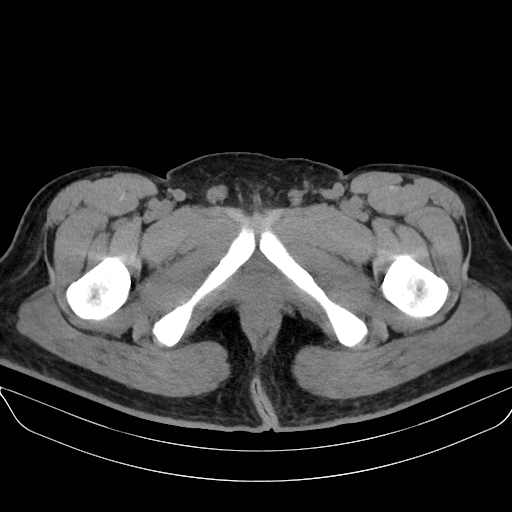 File:Adrenal myelolipoma - bilateral (Radiopaedia 74805-85810 Axial non-contrast 89).jpg