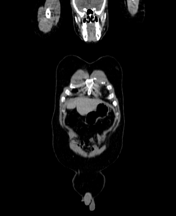 Adrenocortical carcinoma (Radiopaedia 80134-93438 Coronal C+ portal venous phase 24).jpg