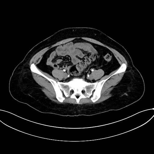 Adrenocortical carcinoma (Radiopaedia 87281-103569 Axial C+ arterial phase 65).jpg