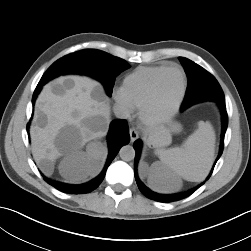 Adult polycystic kidney disease (Radiopaedia 47866-52626 Axial non-contrast 7).png