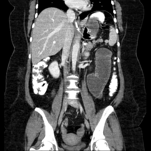 File:Afferent loop syndrome - secondary to incarcerated trocar site hernia (Radiopaedia 82959-97305 Coronal C+ portal venous phase 89).jpg