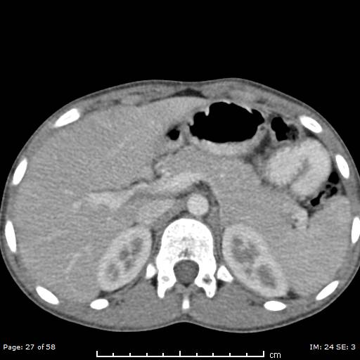 File:Agenesis of the gallbladder (Radiopaedia 55454-61905 B 27).jpg