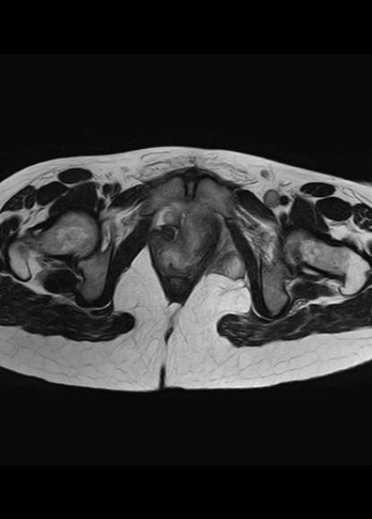 File:Aggressive angiomyxoma of the pelvis and perineum (Radiopaedia 59162-66479 Axial T2 4).jpg