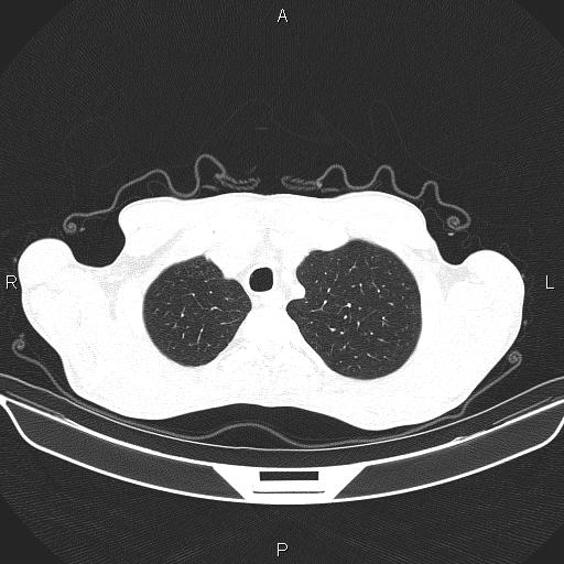 Air bronchogram in pneumonia (Radiopaedia 85719-101512 Axial lung window 11).jpg