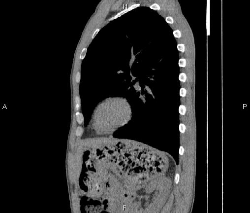 Air bronchogram in pneumonia (Radiopaedia 85719-101512 F 68).jpg