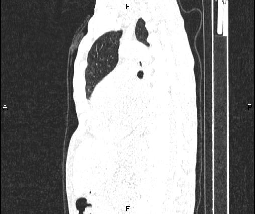File:Air bronchogram in pneumonia (Radiopaedia 85719-101512 Sagittal lung window 55).jpg