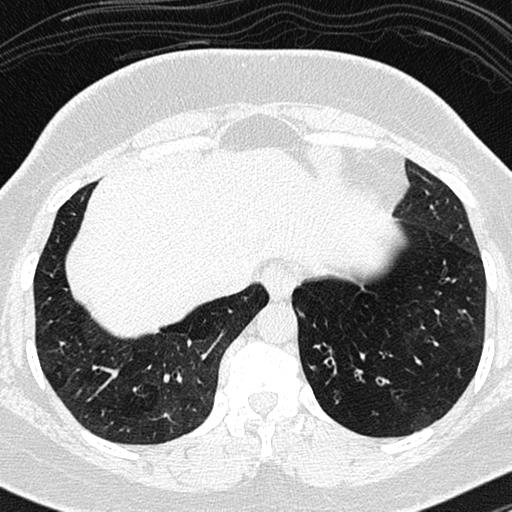 Air trapping in small airway disease (Radiopaedia 61685-69694 Axial lung window 152).jpg