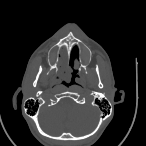 Allergic fungal sinusitis (Radiopaedia 88725-105456 Axial bone window 8).jpg