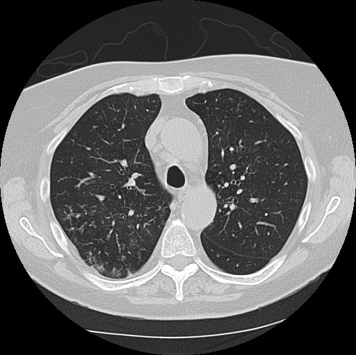 Alpha-1-antitrypsin deficiency (Radiopaedia 72058-82557 Axial lung window 22).jpg