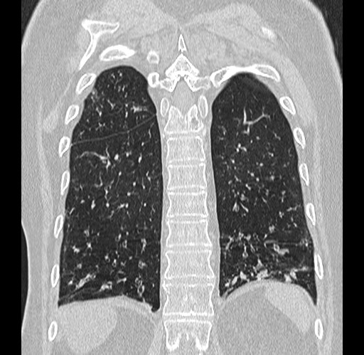 File:Alpha-1-antitrypsin deficiency (Radiopaedia 72058-82557 Coronal lung window 80).jpg