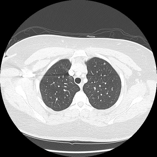 Alveolar soft part sarcoma - right leg (Radiopaedia 59432-67091 Axial lung window 27).jpg