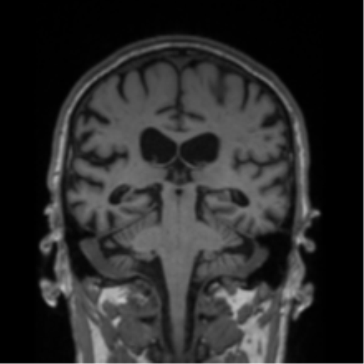 Alzheimer's disease- with Gerstmann syndrome and dressing apraxia (Radiopaedia 54882-61150 Coronal T1 37).png