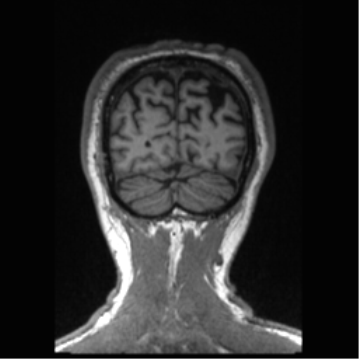 Alzheimer disease - probable (Radiopaedia 35334-36837 Coronal T1 16).png