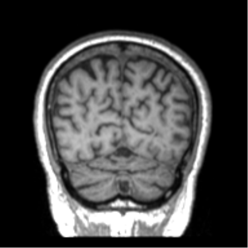 Alzheimer disease and cerebral amyloid angiopathy (Radiopaedia 64234-73011 Coronal T1 4).png