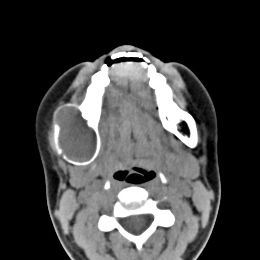 File:Ameloblastoma (Radiopaedia 26645-26793 Axial C+ delayed 15).jpg