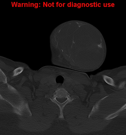 Ameloblastoma (Radiopaedia 33126-34164 Axial bone window 37).jpg