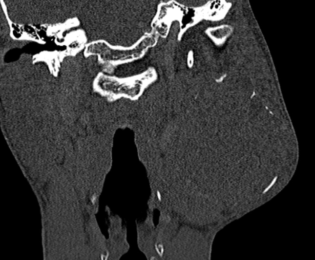 Ameloblastoma (Radiopaedia 51921-57766 Coronal bone window 196).jpg