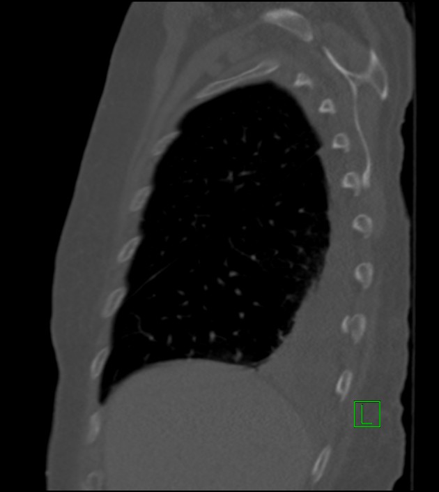 Amiodarone deposition in the liver (Radiopaedia 77587-89780 Sagittal bone window 78).jpg