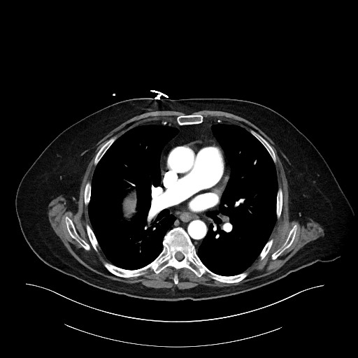 Ampullary adenocarcinoma (Radiopaedia 59373-66734 A 7).jpg
