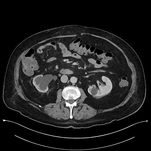 Ampullary adenocarcinoma (Radiopaedia 59373-66737 A 79).jpg