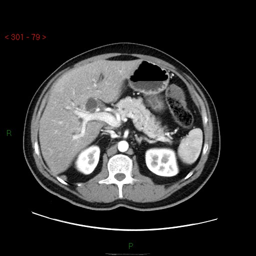 Ampullary carcinoma (Radiopaedia 56396-63056 B 25).jpg