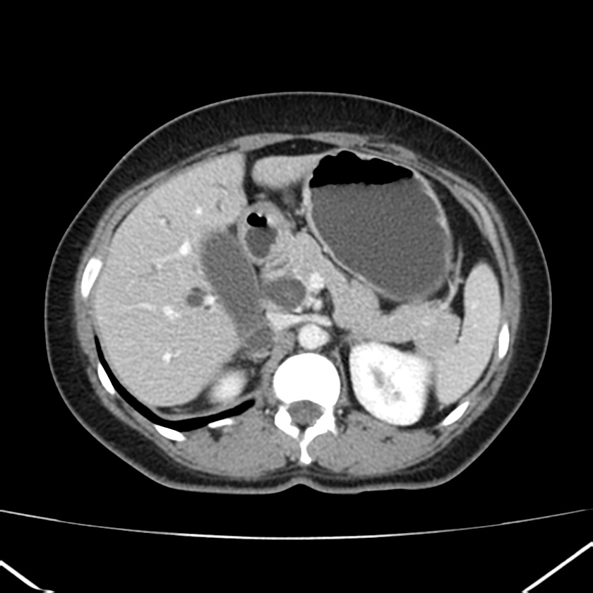 Ampullary tumor (Radiopaedia 22787-22816 C 21).jpg