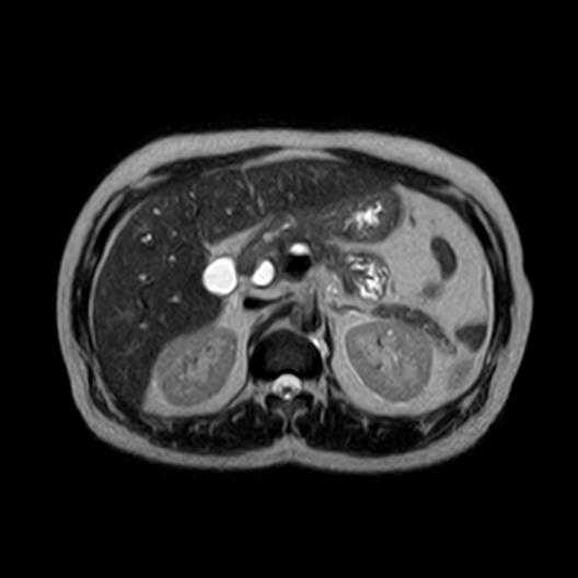 File:Ampullary tumor (Radiopaedia 27294-27479 T2 14).jpg