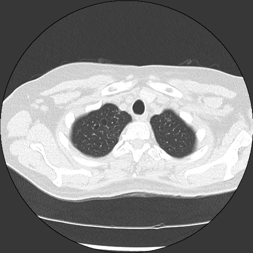 File:Amyloidosis - bronchial and diffuse nodular pulmonary involvement (Radiopaedia 60156-67744 B 8).jpg