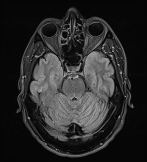 File:Amyotrophic lateral sclerosis (Radiopaedia 87352-103658 Axial FLAIR 9).jpg