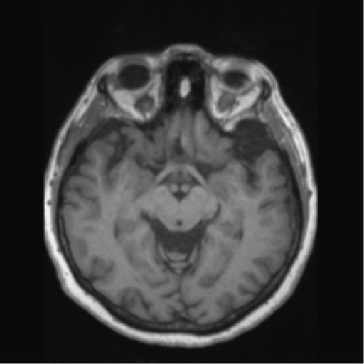 Anaplastic astrocytoma IDH wild-type (pseudoprogression) (Radiopaedia 42209-45276 Axial T1 68).png