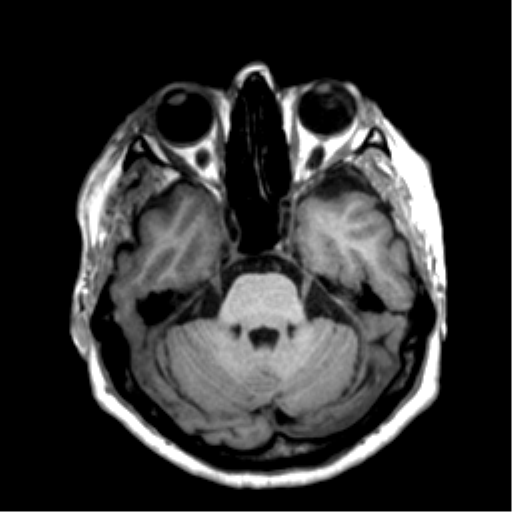 Anaplastic astrocytoma IDH wild-type (pseudoprogression) (Radiopaedia 42209-45277 Axial T1 40).png