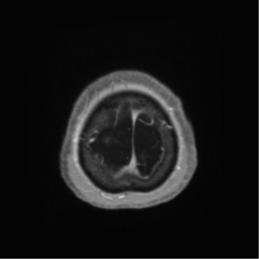 Anaplastic astrocytoma IDH wild-type (pseudoprogression) (Radiopaedia 42209-45278 Axial T1 C+ 143).png