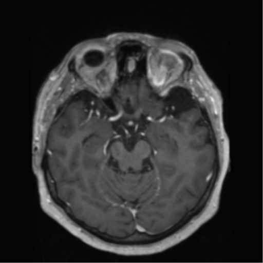 File:Anaplastic astrocytoma IDH wild-type (pseudoprogression) (Radiopaedia 42209-45278 Axial T1 C+ 65).png