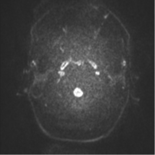 Anaplastic oligodendroglioma (Radiopaedia 37667-39563 Axial DWI 42).png
