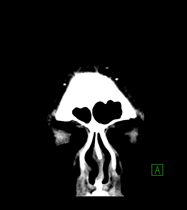 Anaplastic oligodendroglioma (Radiopaedia 79571-92753 Coronal non-contrast 12).jpg