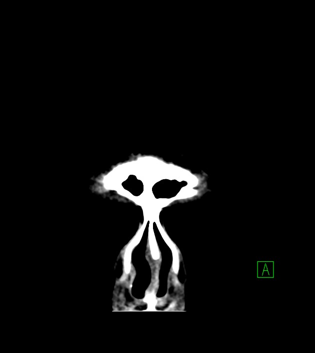 Anaplastic oligodendroglioma (Radiopaedia 79571-92758 Coronal non-contrast 6).jpg