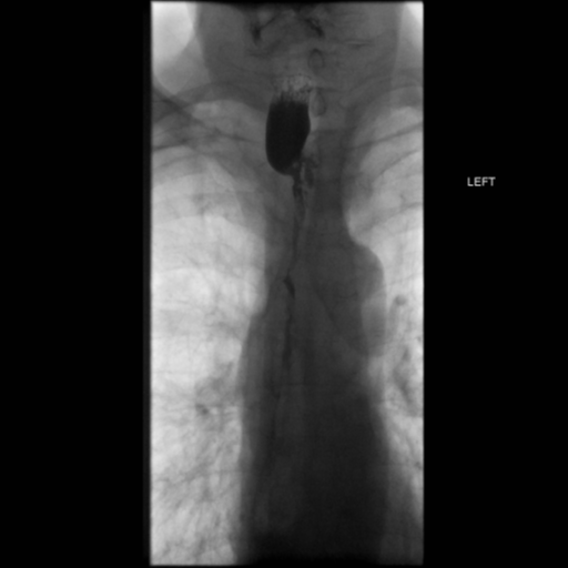 File:Anastomotic stricture post Ivor Lewis esophagectomy (Radiopaedia 47937-52715 B 16).png