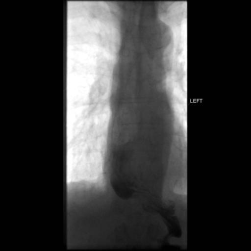 File:Anastomotic stricture post Ivor Lewis esophagectomy (Radiopaedia 47937-52715 C 8).png