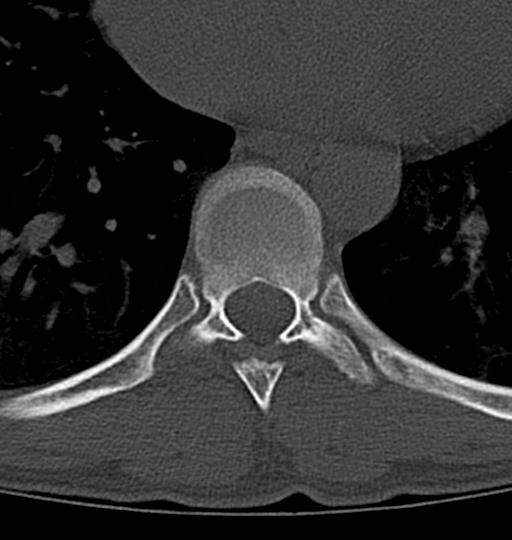 File:Aneurysmal bone cyst T11 (Radiopaedia 29294-29721 Axial bone window 20).jpg