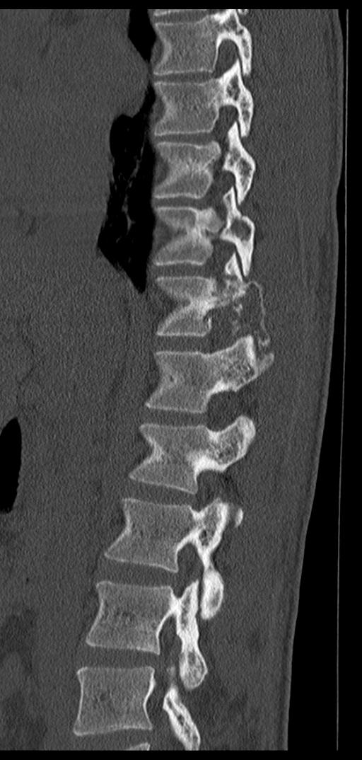 Aneurysmal bone cyst T11 (Radiopaedia 29294-29721 Sagittal bone window 49).jpg