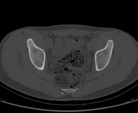 File:Aneurysmal bone cyst of ischium (Radiopaedia 25957-26094 Axial bone window 46).png