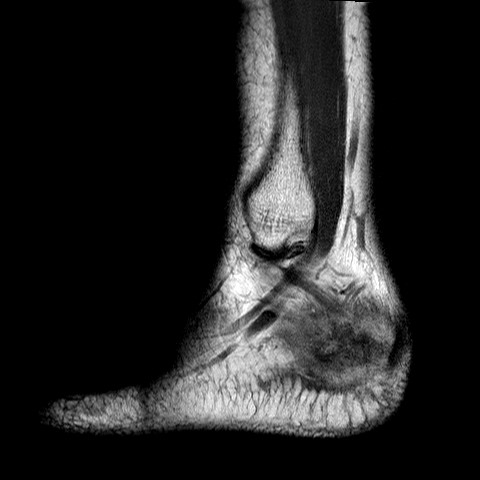 File:Aneurysmal bone cyst of the calcaneus (Radiopaedia 60669-68420 Sagittal PD 2).jpg